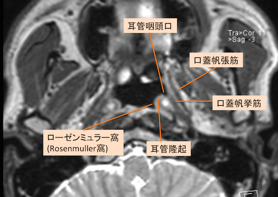 上咽頭癌のMRI画像診断で重要な構造(Rosenmuller窩、Morgani洞 
